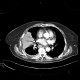 Lobar pneumonia: CT - Computed tomography